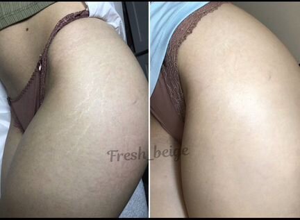 Татуаж растяжек и шрамов